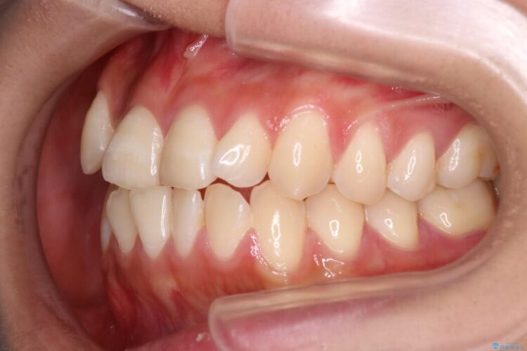 審美装置による非抜歯ワイヤー矯正治療 治療前画像