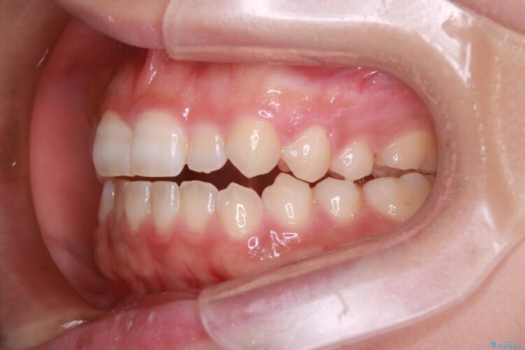 インビザライン矯正で短期間で開咬を改善 治療前画像