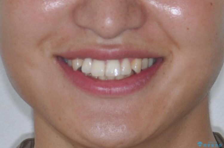 インビザラインで前歯の凸凹をきれいに 治療前画像