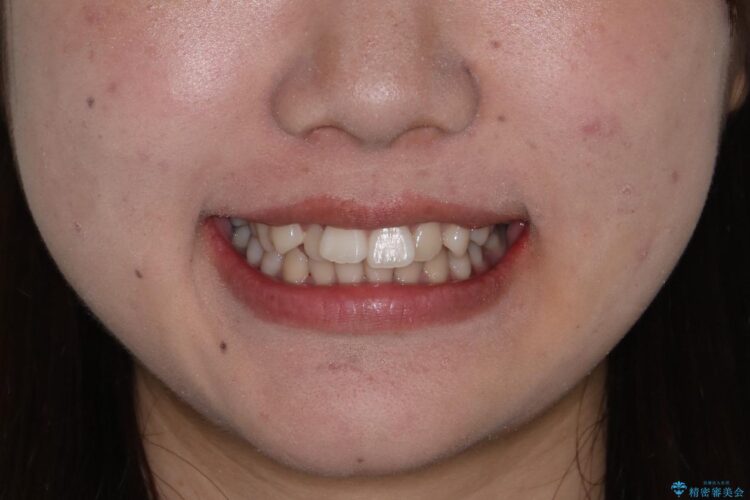 抜歯矯正で口元スッキリ きれいな笑顔に 治療前画像