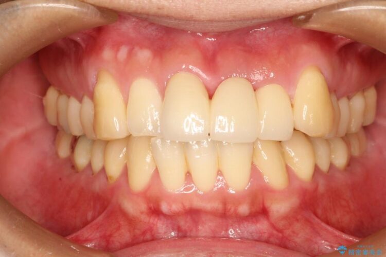 前歯のブリッジ治療 アフター