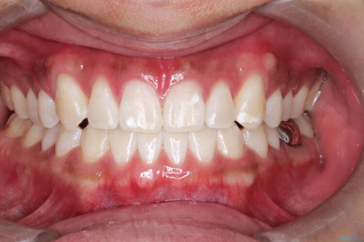 オフィスホワイトニングで歯を白く（エクセレントコース） 治療後画像