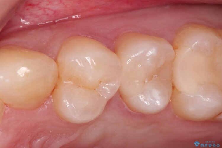 早期発見・早期むし歯治療(セラミックインレーにて修復) アフター
