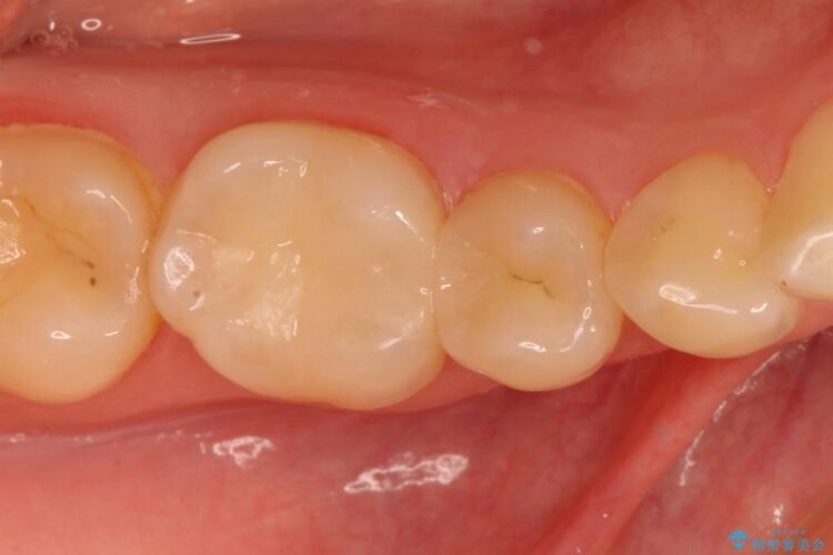 隙間のないセラミックインレーで虫歯治療 アフター