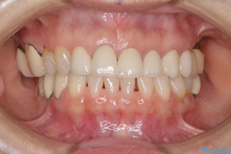 歯茎との境目が黒くなってきた差し歯のオールセラミック治療 アフター