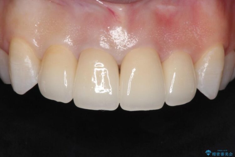 精密治療による前歯の被せ物 アフター