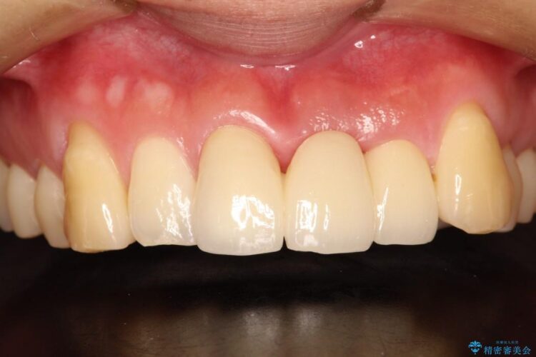 前歯のブリッジ治療 治療後画像