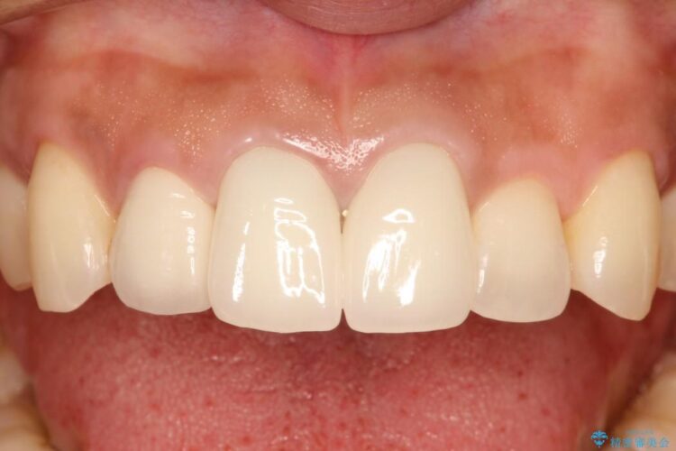 前歯の黒ずみをオールセラミックで改善 治療後画像