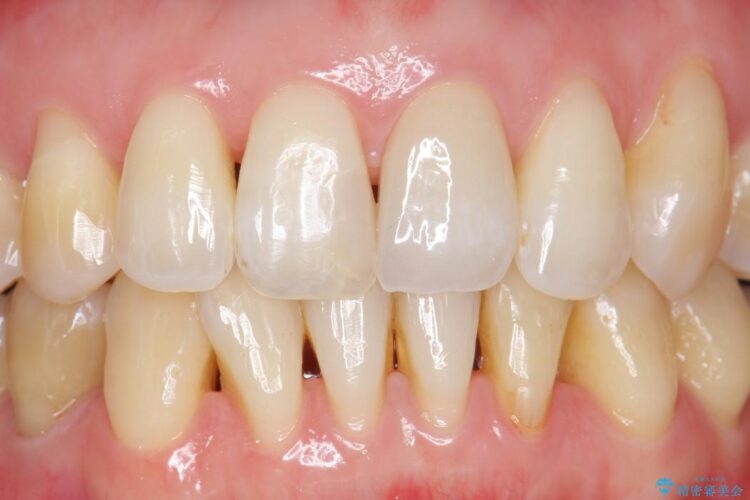 気になる前歯の変色をセラミックのかぶせ物で治療 治療後画像