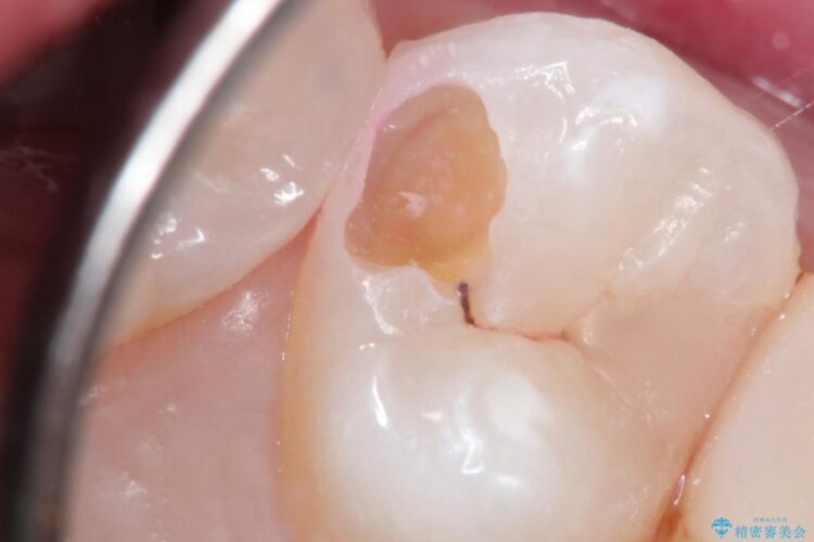 早期発見・早期むし歯治療(セラミックインレーにて修復) 治療後画像