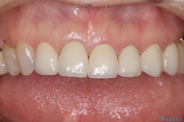 歯茎との境目が黒くなってきた差し歯のオールセラミック治療 治療後画像
