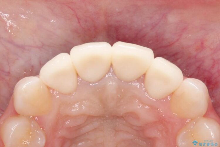 精密治療による前歯の被せ物 治療後画像
