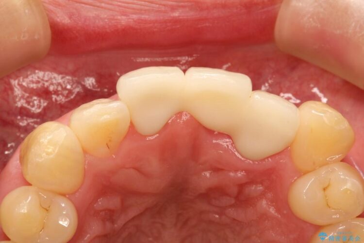 前歯のブリッジ治療 治療後画像