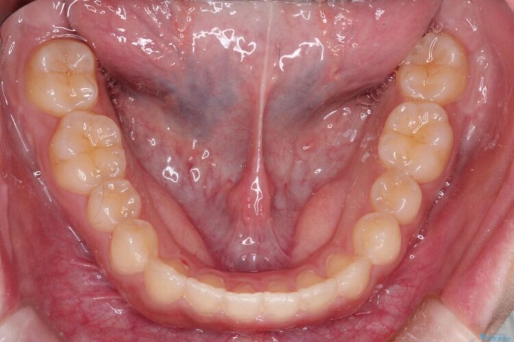 インビザライン矯正で短期間で開咬を改善 治療後画像