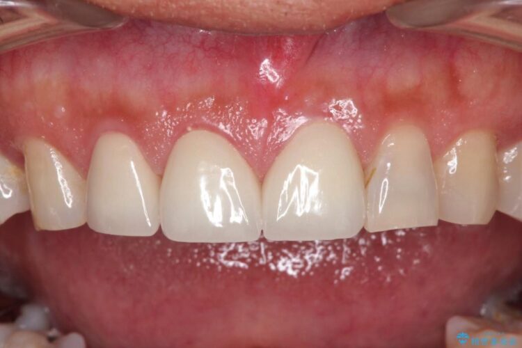 オールセラミックで前歯の隙間を改善 治療後画像