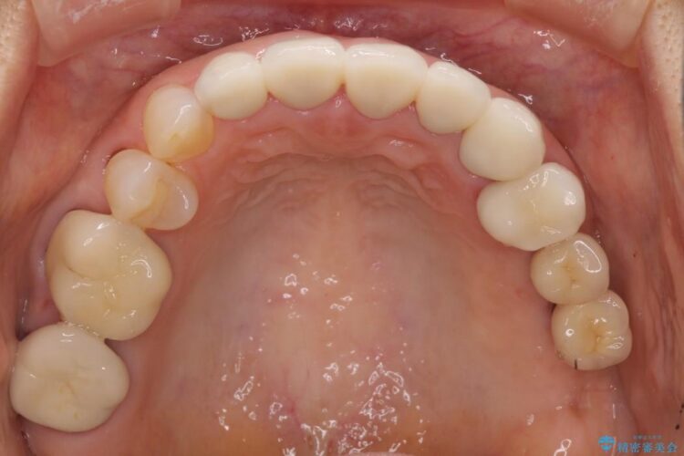 歯茎との境目が黒くなってきた差し歯のオールセラミック治療 治療後画像