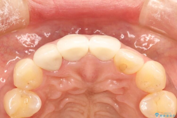 前歯の黒ずみをオールセラミックで改善 治療後画像