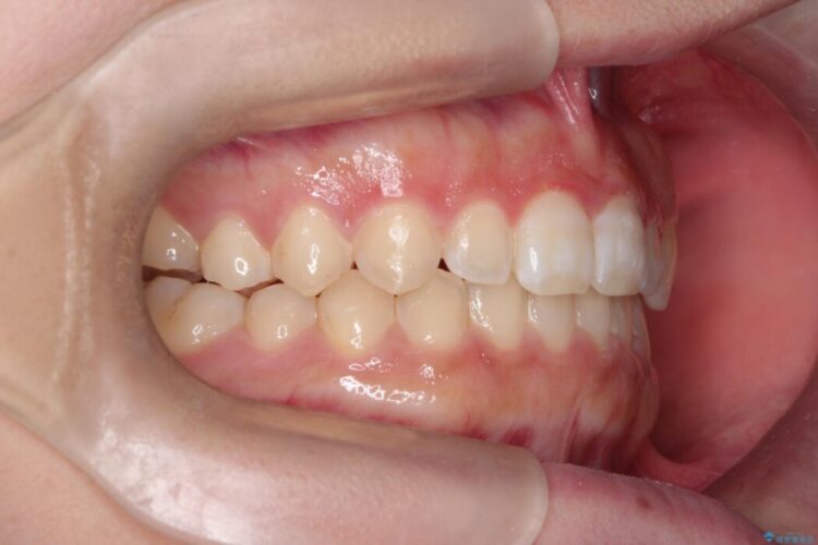 インビザライン矯正で短期間で開咬を改善 治療後画像
