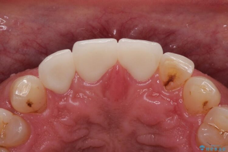 オールセラミックで前歯の隙間を改善 治療後画像