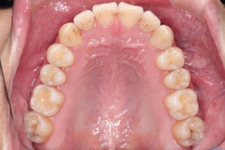 インビザラインで前歯の凸凹をきれいに 治療後画像