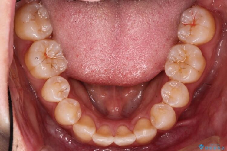 残っていた乳歯を抜歯して矯正治療 治療後画像