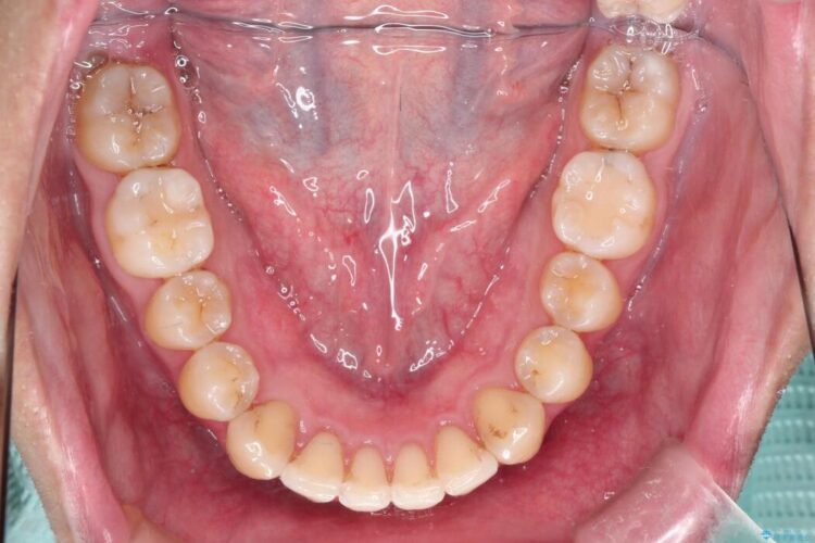 インビザラインで前歯の凸凹をきれいに 治療後画像