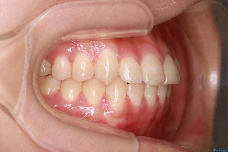 審美装置による非抜歯ワイヤー矯正治療 治療後画像