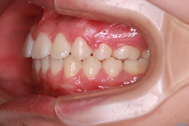 抜歯矯正で口元スッキリ きれいな笑顔に 治療後画像