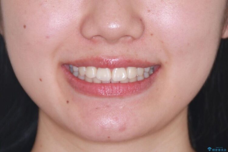 抜歯矯正で口元スッキリ きれいな笑顔に 治療後画像