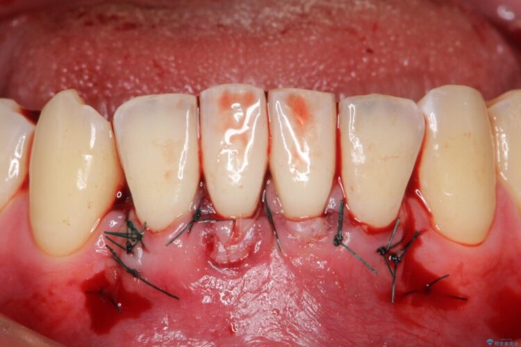 下顎前歯の歯ぐき退縮を歯肉移植による根面被覆で改善 治療途中画像