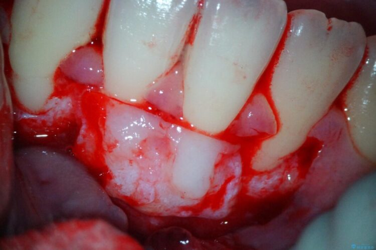 結合組織移植術で下がった歯肉を再生 治療途中画像