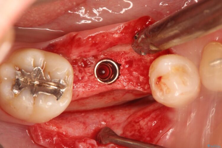 インプラント治療でしっかり噛める奥歯に 治療途中画像
