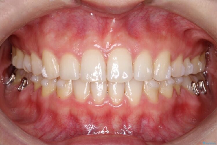インビザラインで前歯のガタガタ（叢生）を綺麗に 治療途中画像