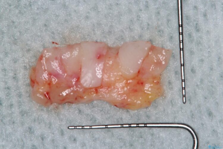 下顎前歯の歯ぐき退縮を歯肉移植による根面被覆で改善 治療途中画像