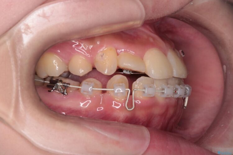 【二重歯列】重度の叢生をハーフリンガルで治療 治療途中画像