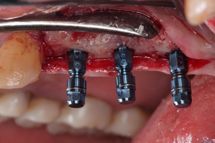 抜歯した奥歯部分に歯を入れたい 治療途中画像
