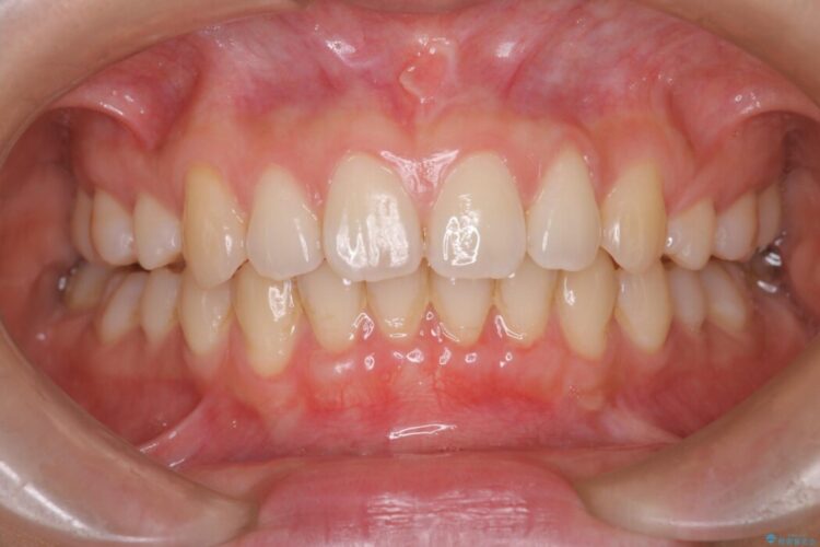 エムドゲインで骨を再生し、歯茎の移植で前歯の歯肉退縮をきれいに 治療途中画像