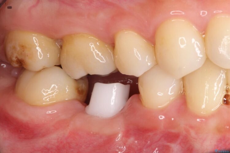 インプラント治療でしっかり噛める奥歯に 治療途中画像