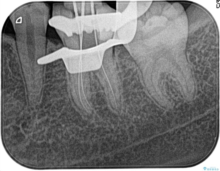 【20代女性】昨晩から奥歯が激痛 精密根管治療（イニシャルケース） 治療途中画像