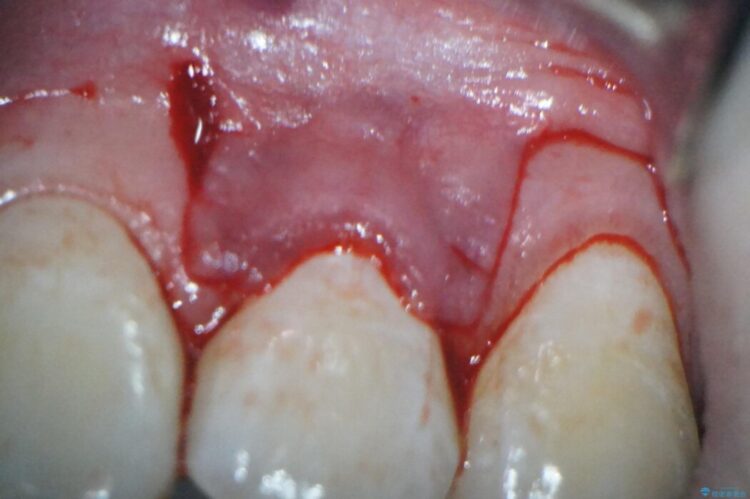 前歯の歯肉退縮を歯肉弁歯冠側移動術で改善 治療途中画像
