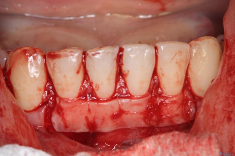 エムドゲインで骨を再生し、歯茎の移植で前歯の歯肉退縮をきれいに 治療途中画像