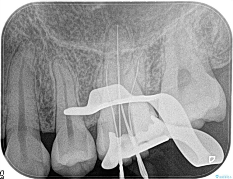 ズキズキ痛む奥歯を精密根管治療で解決 治療途中画像