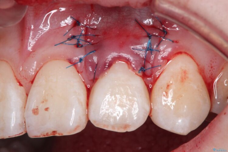 前歯の歯肉退縮を歯肉弁歯冠側移動術で改善 治療途中画像