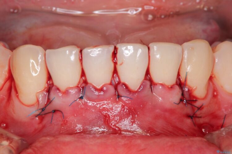 エムドゲインで骨を再生し、歯茎の移植で前歯の歯肉退縮をきれいに 治療途中画像