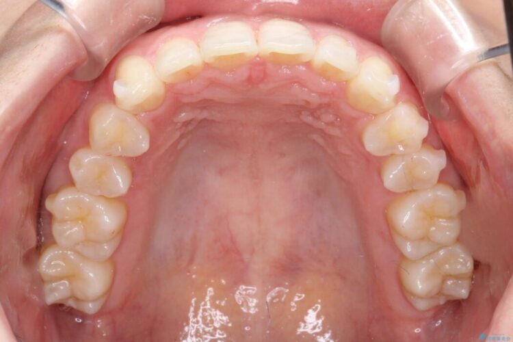 インビザラインで前歯のガタガタ（叢生）を綺麗に 治療途中画像
