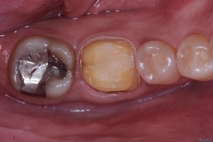 冷たいもので奥歯が痛む。精密根管治療とオールセラミッククラウン 治療途中画像