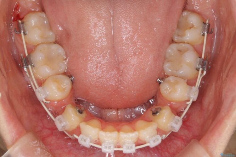 ハーフリンガルで目立たず、口ゴボの改善 治療途中画像