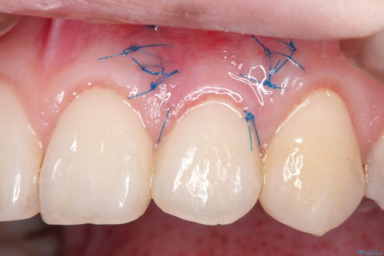 前歯の歯肉退縮を歯肉弁歯冠側移動術で改善 治療途中画像