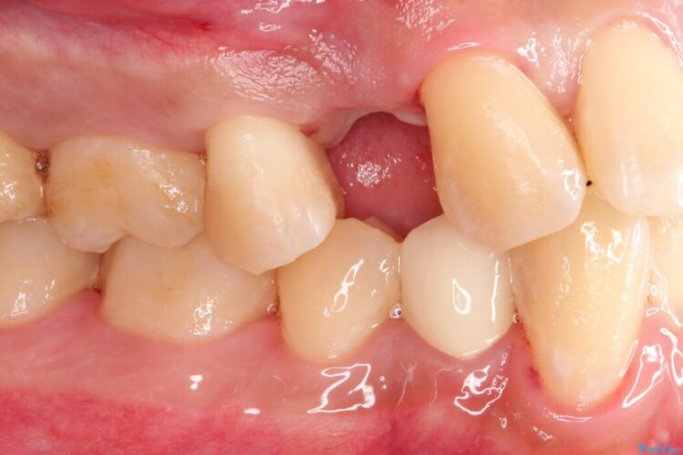上顎4番のインプラント治療 治療前画像