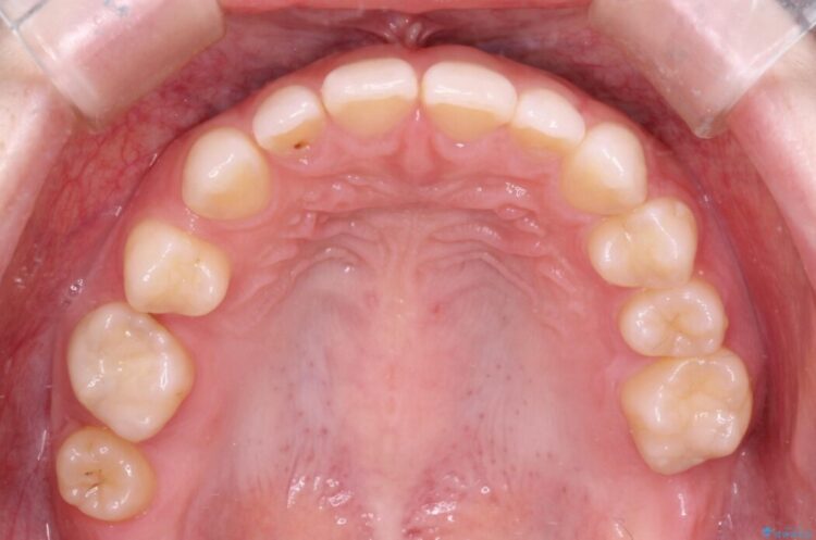 気になる隙間を矯正治療とインプラント治療で改善 治療前画像